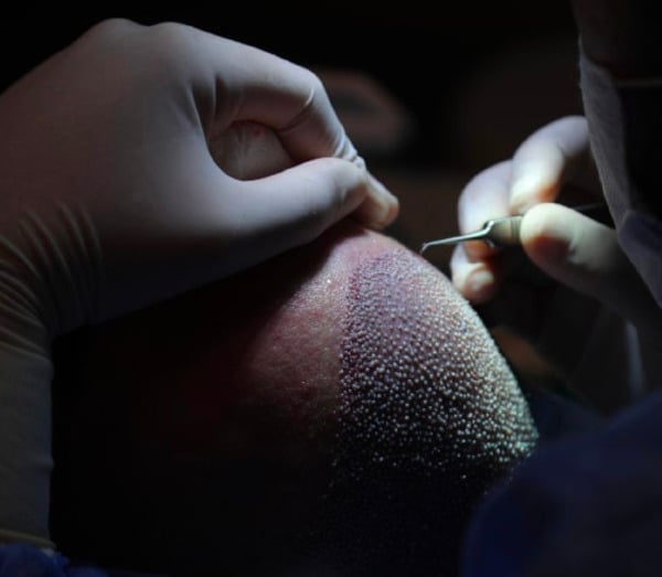 Channels being opened for the transplanted hairs to be inserted into