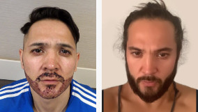 Comparing the before and after of a beard transplant