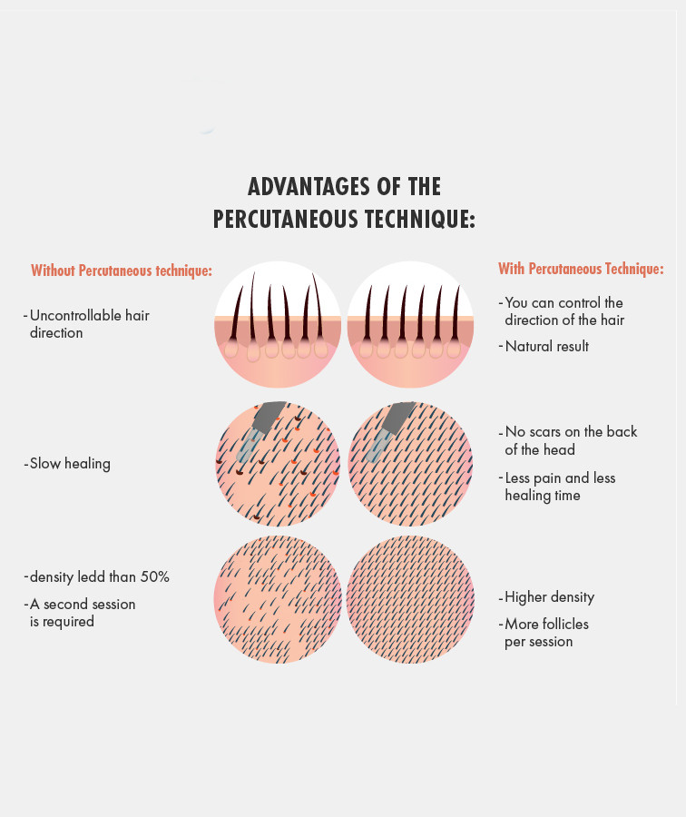 Graphic showing the differences between a hair transplant with the percutaneous technique compared to without it.