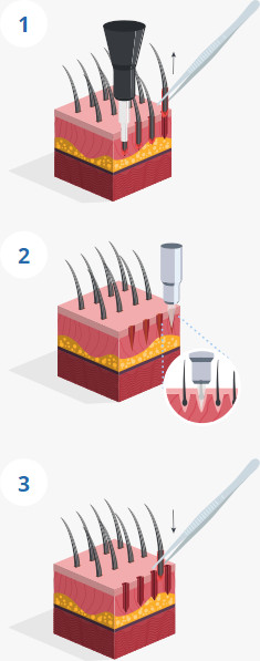 Infographic explaining the stages of the Percutaneous Hair Transplant