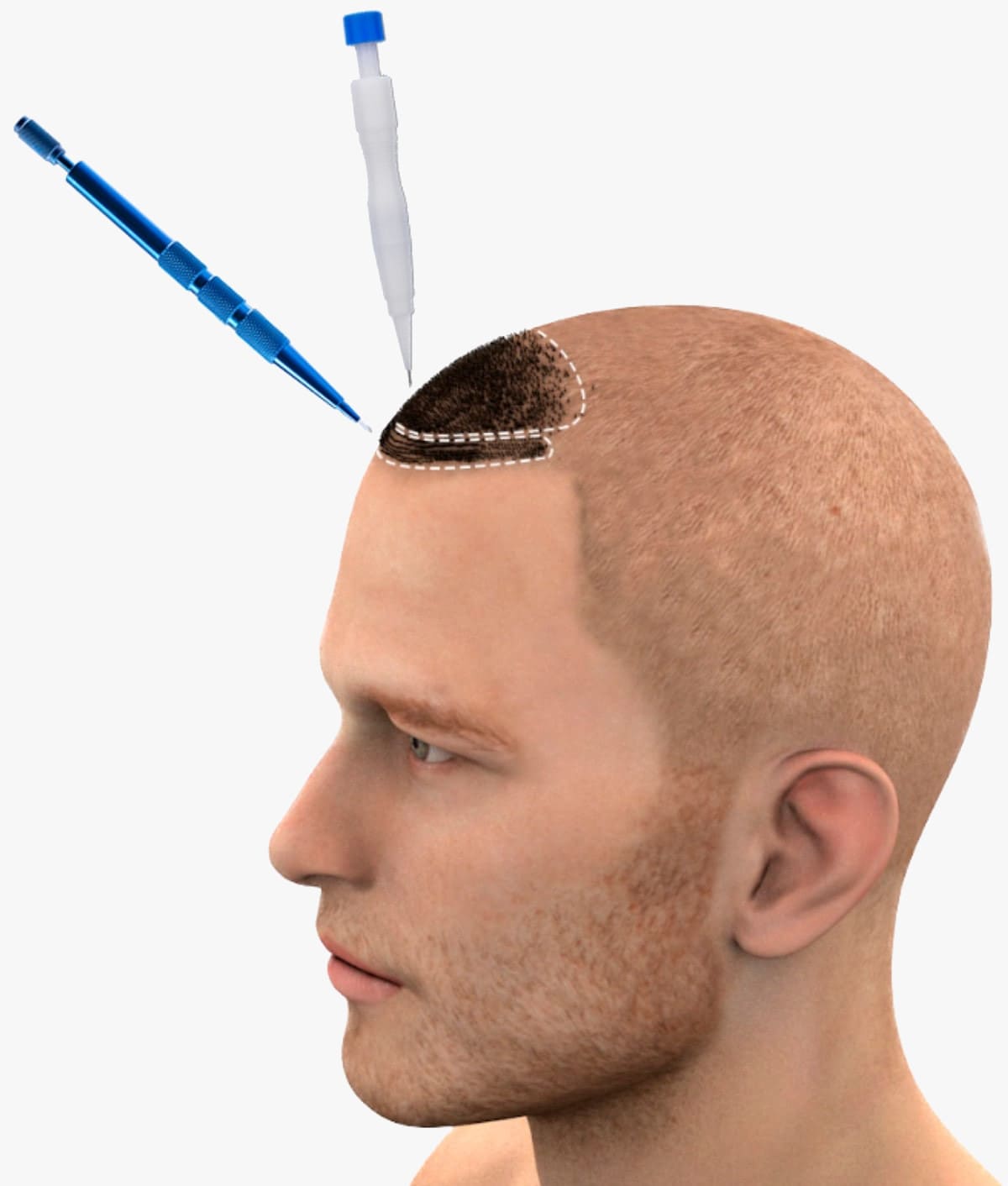 The SDHI hair transplant combines the DHI method with the Sapphire method