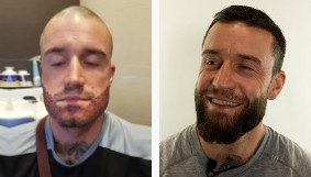 The impressive results of a hair transplant and beard transplant