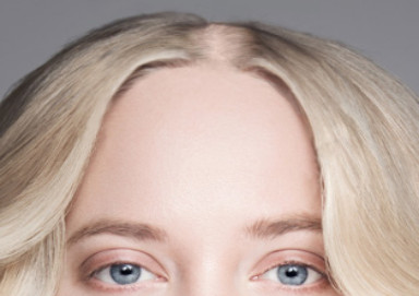 Woman with diffuse hair loss along her parting