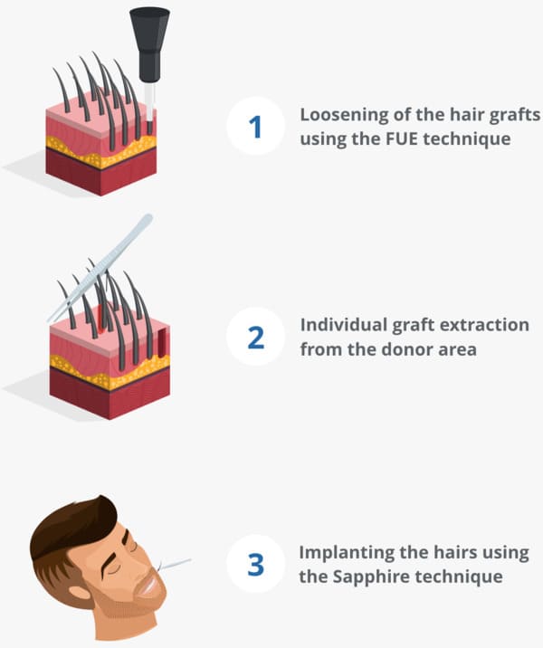 Infographic showing the beard transplant process