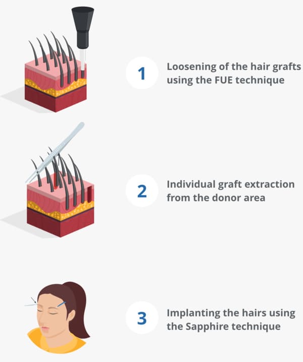 An infographic explaining the eyebrow transplant procedure