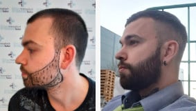 what does a beard transplant look like after