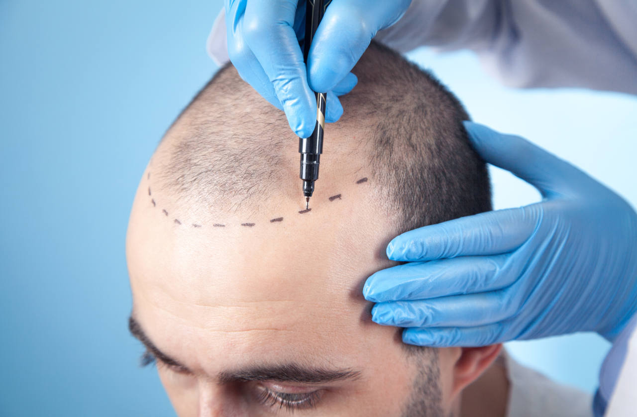 A hair transplant patient having his new hairline drawn on