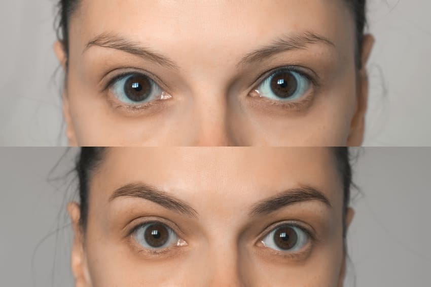 Before and after an eyebrow treatment