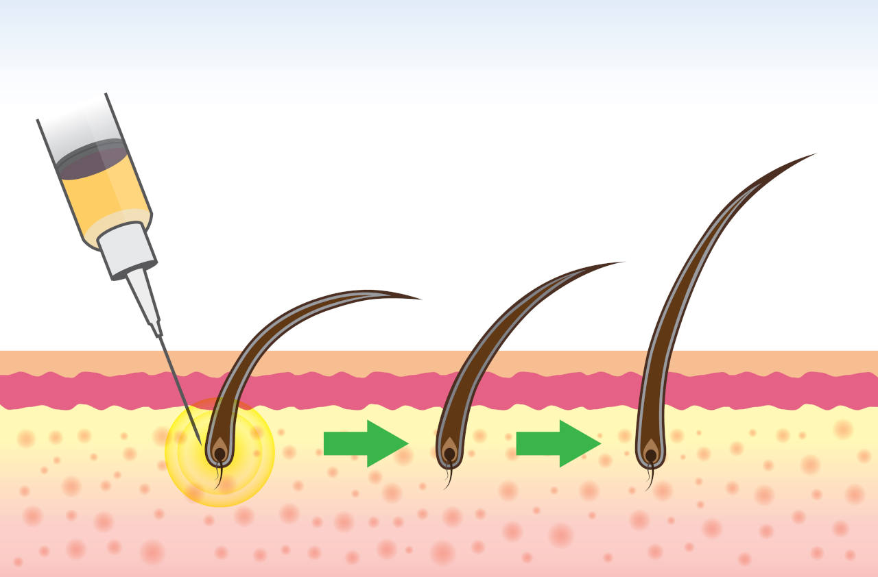 Hair follicle treatment where stem cells are injected into the scalp
